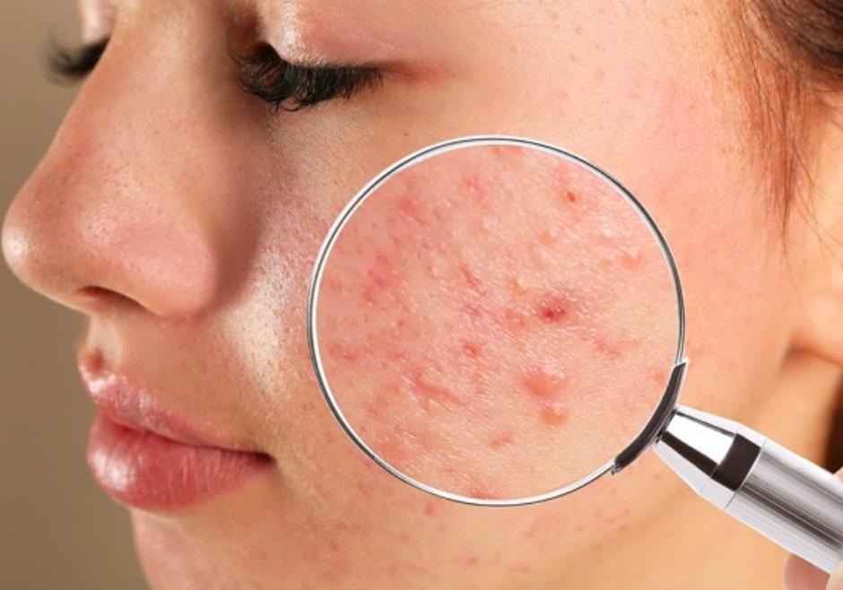 Điều gì khiến gel mụn Actidem được lòng các chuyên gia da liễu?- Ảnh 1.