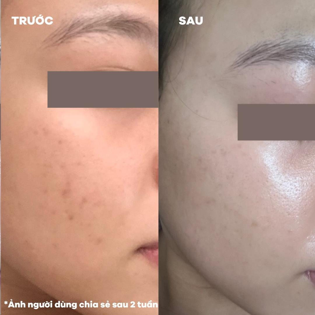 Chỉ sau 2 tuần "độ da", từ mụn ẩn thâm lâu hóa căng bóng đều màu - Bí kíp quen mà lạ!- Ảnh 1. Chỉ sau 2 tuần "độ da", từ mụn ẩn thâm lâu hóa căng bóng đều màu - Bí kíp quen mà lạ!- Ảnh 1.