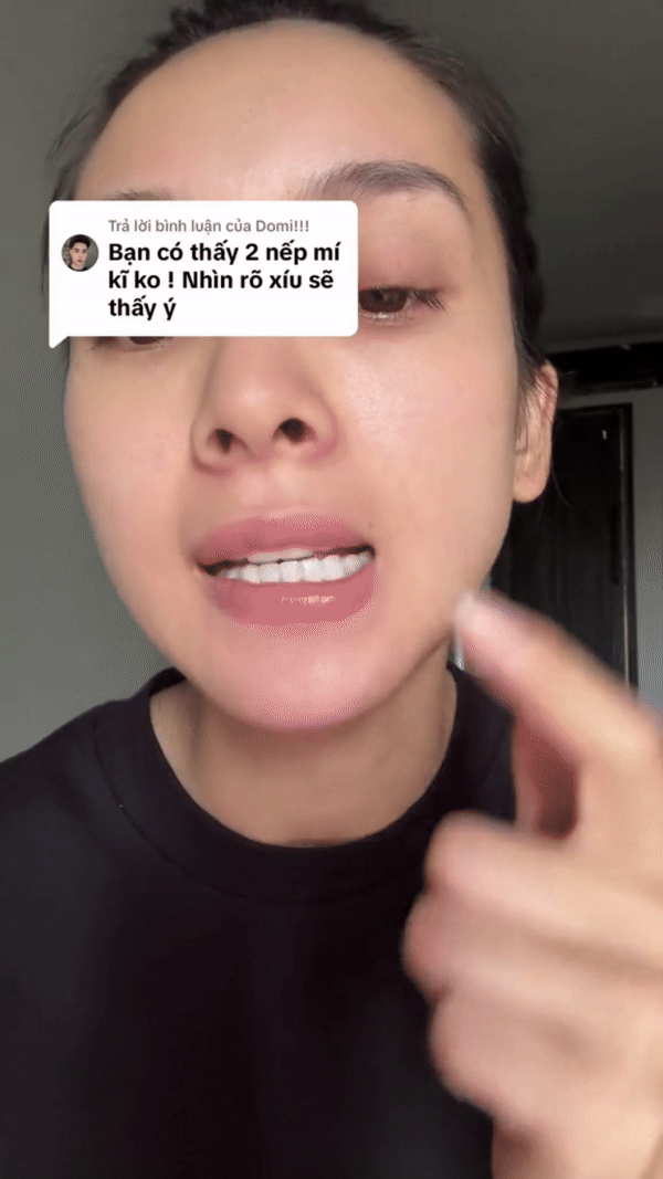 Mỹ nhân vừa vượt mặt Tiểu Vy “thừa nhận” phẫu thuật thẩm mỹ, chỉ đích danh bác sĩ của mình- Ảnh 9. Mỹ nhân vừa vượt mặt Tiểu Vy “thừa nhận” phẫu thuật thẩm mỹ, chỉ đích danh bác sĩ của mình- Ảnh 9.
