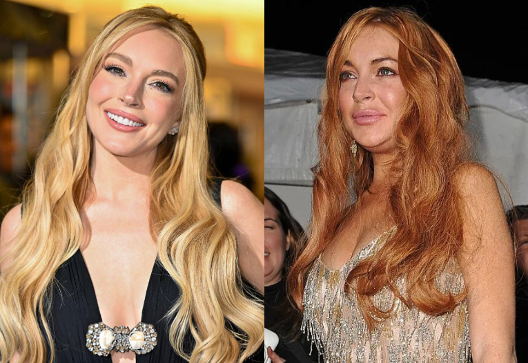 Bác sĩ thẩm mỹ nào có thể cứu vớt nhan sắc "cận date" như Lindsay Lohan cùng loạt sao Hollywood?- Ảnh 3.