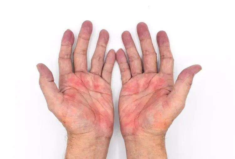 Bác sĩ ung bướu tiết lộ "điềm báo" ung thư lộ rõ trên bàn tay: Có 3 điểm bất thường nên đi khám khẩn cấp- Ảnh 2.