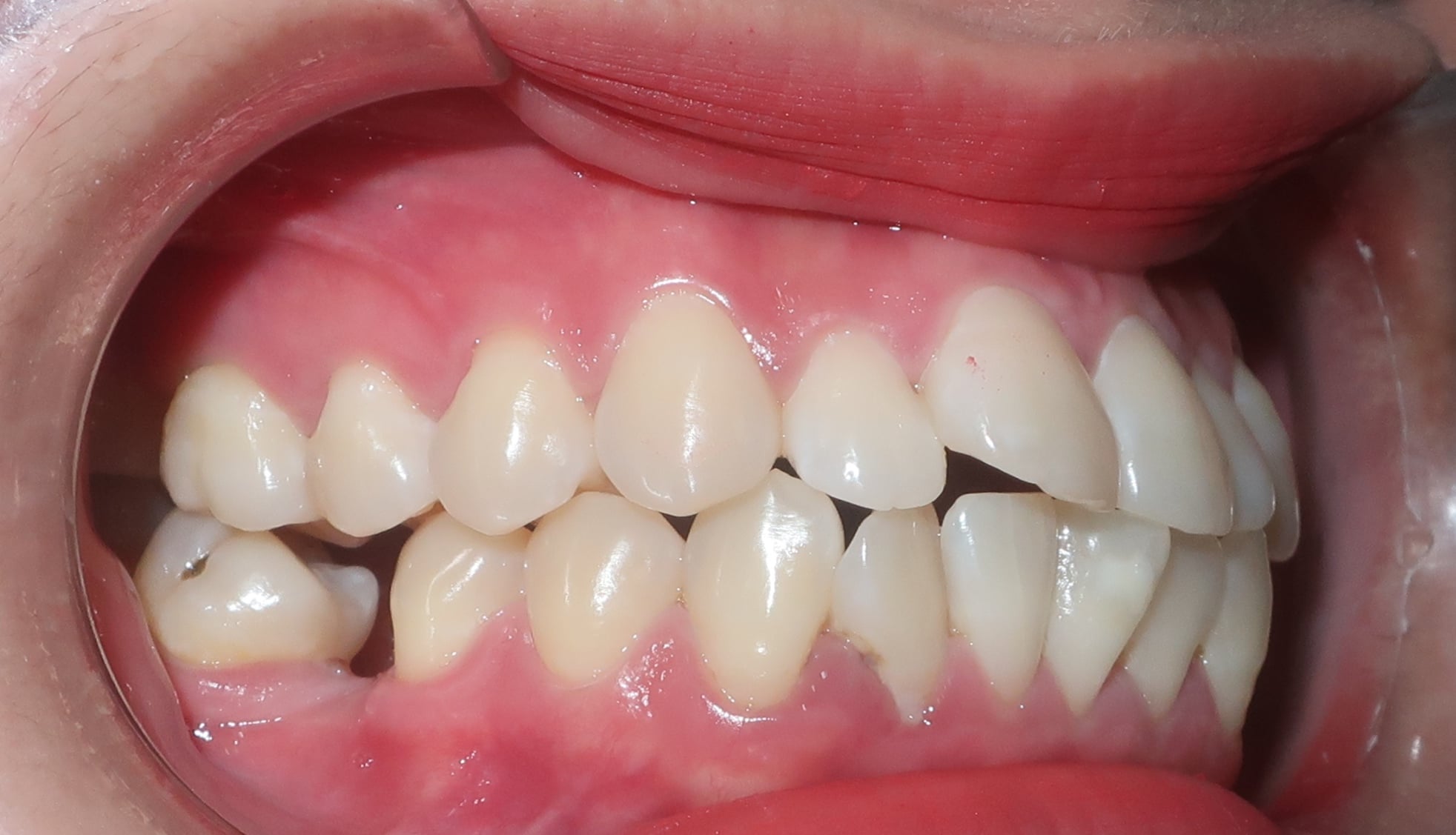 Bác sĩ bật mí: Đây chính xác là những điều niềng răng sẽ làm thay đổi trên khuôn mặt bạn!- Ảnh 2. Bác sĩ bật mí: Đây chính xác là những điều niềng răng sẽ làm thay đổi trên khuôn mặt bạn!- Ảnh 2.