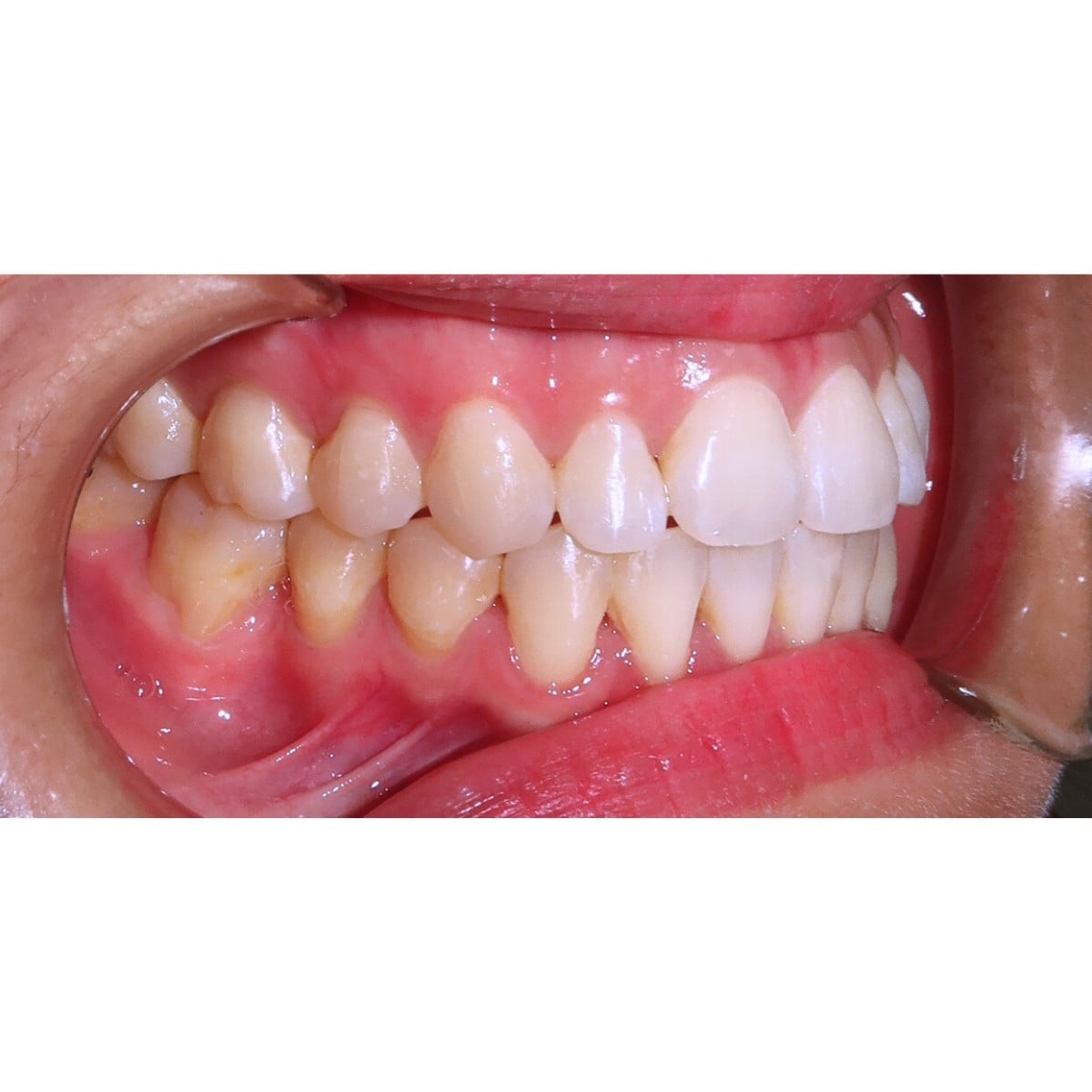 Bác sĩ bật mí: Đây chính xác là những điều niềng răng sẽ làm thay đổi trên khuôn mặt bạn!- Ảnh 3. Bác sĩ bật mí: Đây chính xác là những điều niềng răng sẽ làm thay đổi trên khuôn mặt bạn!- Ảnh 3.