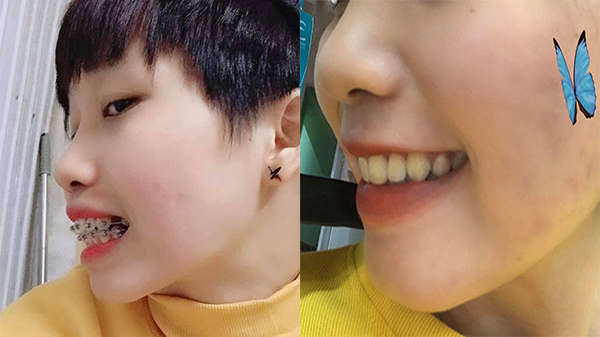 Bác sĩ bật mí: Đây chính xác là những điều niềng răng sẽ làm thay đổi trên khuôn mặt bạn!- Ảnh 4. Bác sĩ bật mí: Đây chính xác là những điều niềng răng sẽ làm thay đổi trên khuôn mặt bạn!- Ảnh 4.