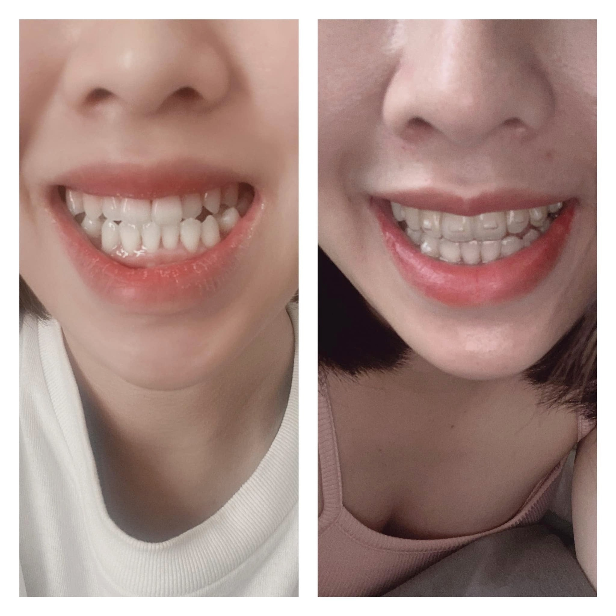 Bác sĩ bật mí: Đây chính xác là những điều niềng răng sẽ làm thay đổi trên khuôn mặt bạn!- Ảnh 6. Bác sĩ bật mí: Đây chính xác là những điều niềng răng sẽ làm thay đổi trên khuôn mặt bạn!- Ảnh 6.