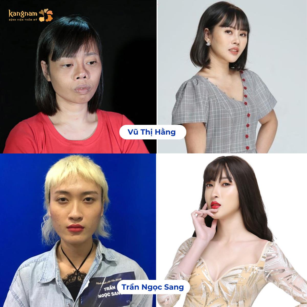 TOP 10 ca lột xác xuất sắc tại bệnh viện thẩm mỹ Kangnam- Ảnh 2. TOP 10 ca lột xác xuất sắc tại bệnh viện thẩm mỹ Kangnam- Ảnh 2.