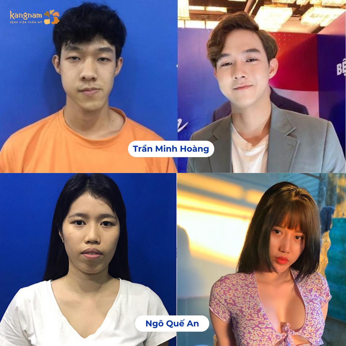 TOP 10 ca lột xác xuất sắc tại bệnh viện thẩm mỹ Kangnam- Ảnh 3. TOP 10 ca lột xác xuất sắc tại bệnh viện thẩm mỹ Kangnam- Ảnh 3.