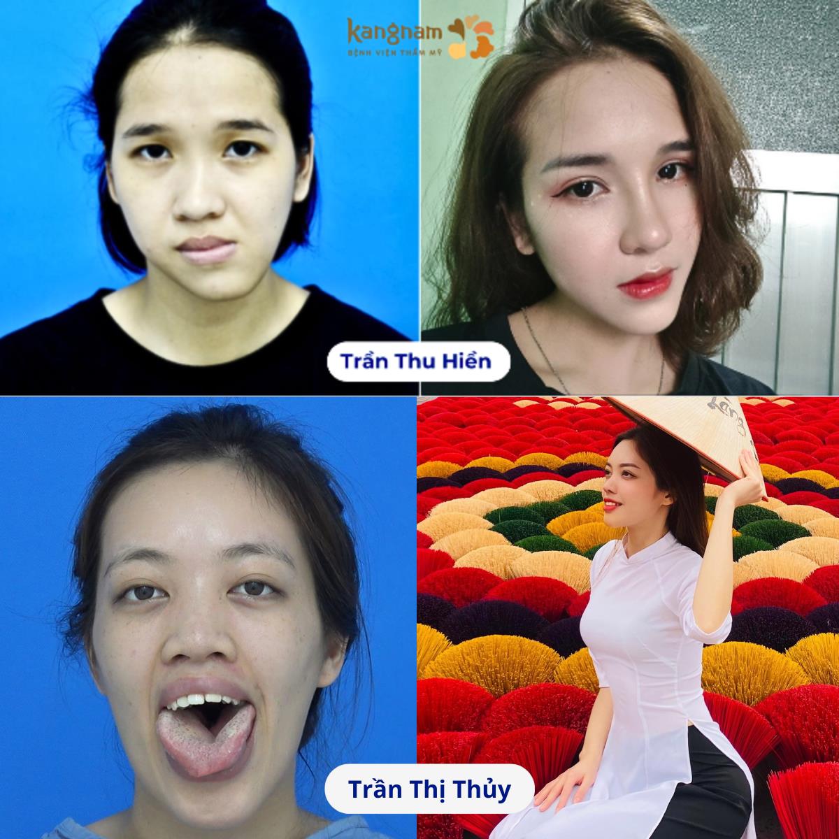TOP 10 ca lột xác xuất sắc tại bệnh viện thẩm mỹ Kangnam- Ảnh 4. TOP 10 ca lột xác xuất sắc tại bệnh viện thẩm mỹ Kangnam- Ảnh 4.