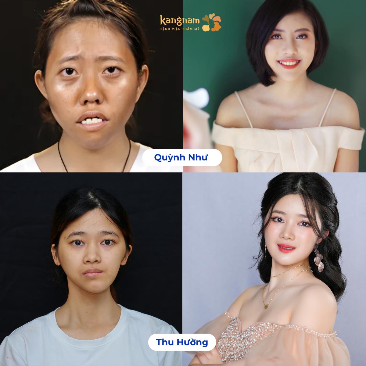 TOP 10 ca lột xác xuất sắc tại bệnh viện thẩm mỹ Kangnam- Ảnh 5. TOP 10 ca lột xác xuất sắc tại bệnh viện thẩm mỹ Kangnam- Ảnh 5.