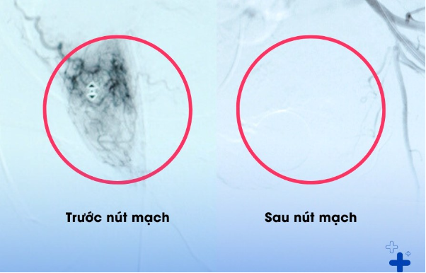 5 tháng bí tiểu, tiểu máu, bệnh nhân bay từ Úc về Việt Nam để nút mạch tuyến tiền liệt- Ảnh 2.