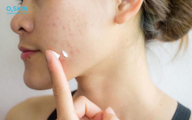 6 sai lầm khi dùng thuốc bôi hỗ trợ trị mụn và lời khuyên từ bác sĩ da liễu- Ảnh 1.