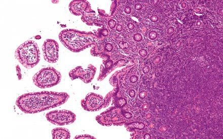 23 tuổi phát hiện mắc bệnh hiểm nghèo, cô gái trẻ không ngờ những dấu hiệu đã xuất hiện cả tháng trước đó- Ảnh 2.