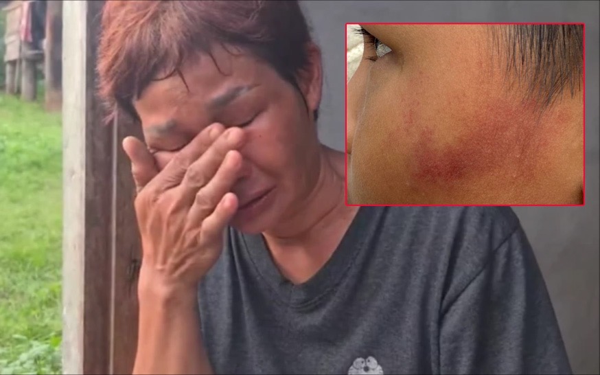 Bé trai 7 tuổi bị cô giáo dùng thước sắt đánh 14 lần vì ăn một viên kẹo - Ảnh 1.