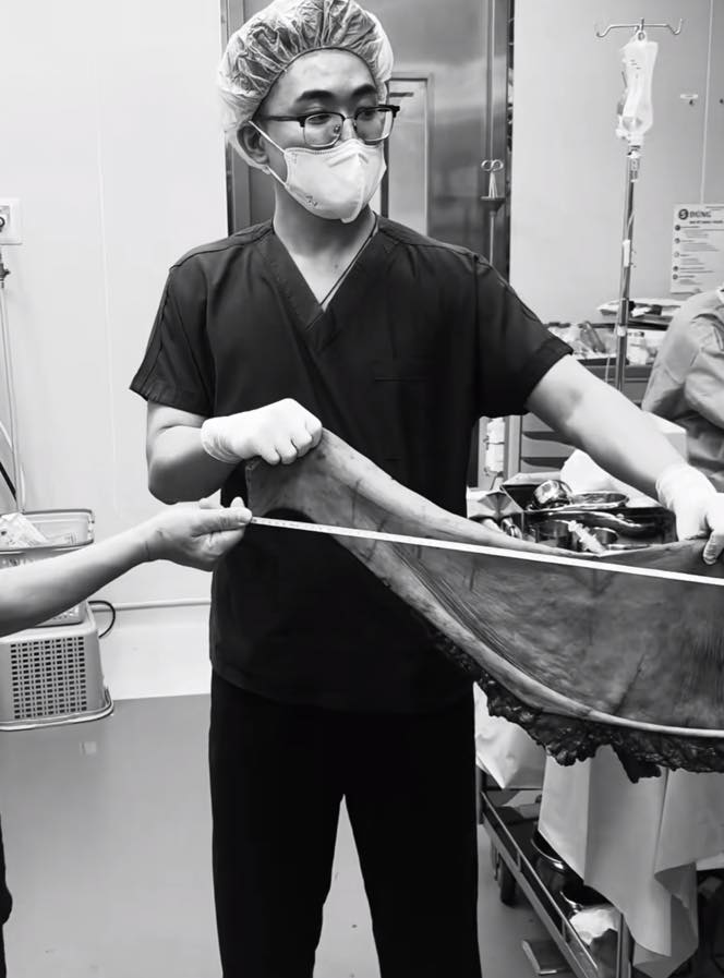 Cận cảnh bộ da thừa dài 171cm, nặng 6kg được cắt bỏ thành công của chàng thanh niên từng nặng 264kg- Ảnh 3.