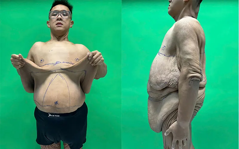 Cận cảnh bộ da thừa dài 171cm, nặng 6kg được cắt bỏ thành công của chàng thanh niên từng nặng 264kg- Ảnh 6.