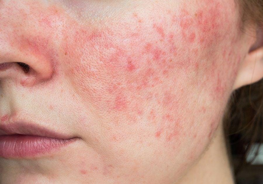 Chăm da nhiễm corticoid cùng chuyên gia da liễu Thành Nguyễn Skin- Ảnh 2. Chăm da nhiễm corticoid cùng chuyên gia da liễu Thành Nguyễn Skin- Ảnh 2.
