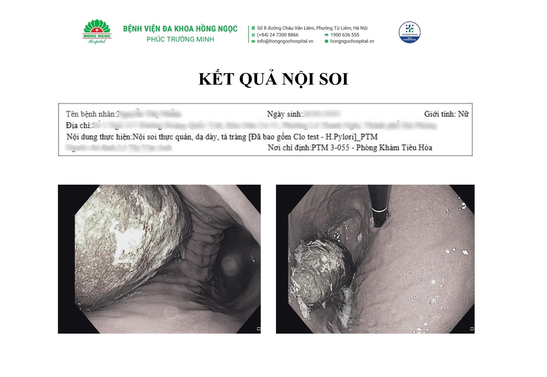 Nội soi lấy khối bã thức ăn "khổng lồ" 15cm trong dạ dày- Ảnh 1. Nội soi lấy khối bã thức ăn "khổng lồ" 15cm trong dạ dày- Ảnh 1.