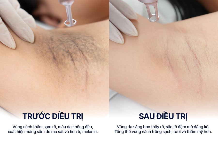 Sự thật về laser trị thâm: Điều bạn cần biết trước khi điều trị- Ảnh 3. Sự thật về laser trị thâm: Điều bạn cần biết trước khi điều trị- Ảnh 3.