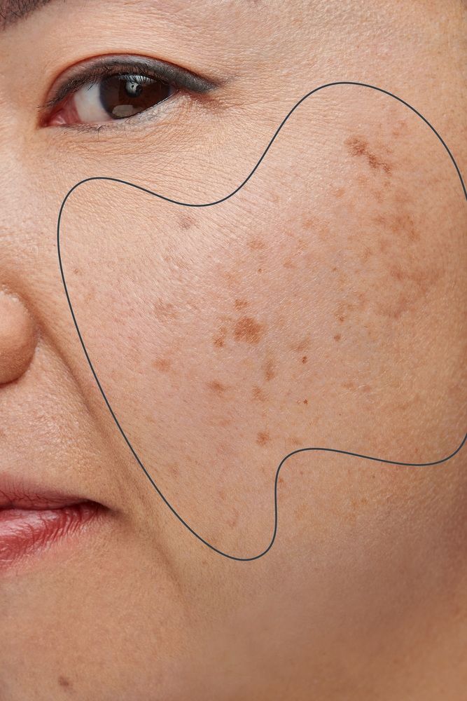 Trị nám tuổi 40 không hề khó nếu bạn bổ sung 2 dưỡng chất này mỗi ngày, phụ nữ trung niên càng nên áp dụng - Ảnh 2.