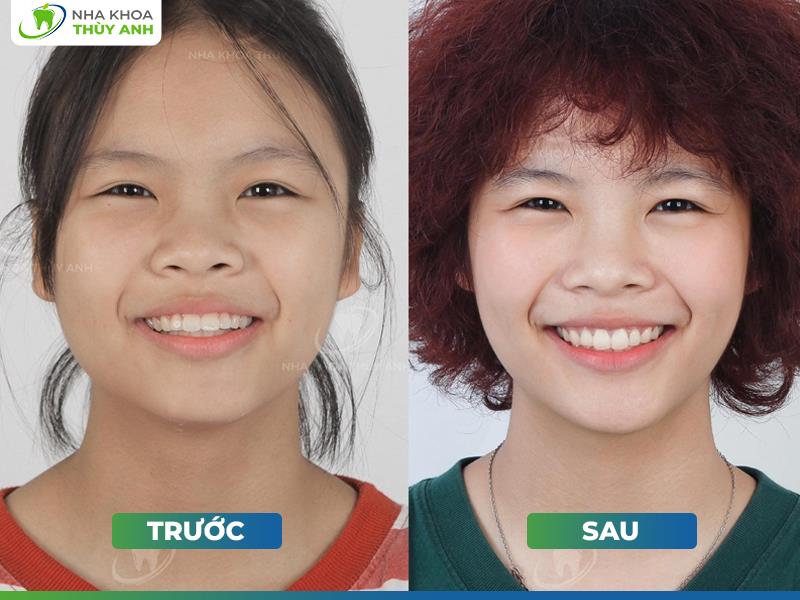 Hành trình kết nối nụ cười của bác sĩ Phương Thảo tại nha khoa Thùy Anh- Ảnh 4. Hành trình kết nối nụ cười của bác sĩ Phương Thảo tại nha khoa Thùy Anh- Ảnh 4.