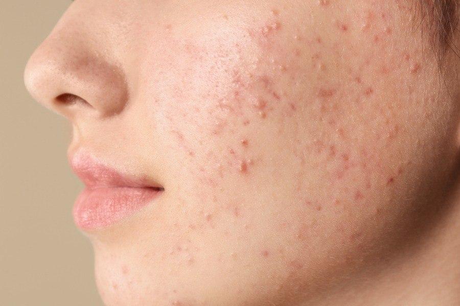 Trị thâm mụn thế nào cho hiệu quả và an toàn? Góc nhìn từ chuyên gia thẩm mỹ- Ảnh 2.