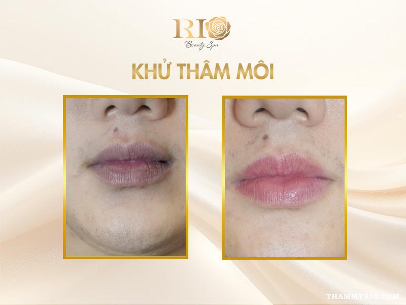 Hết thâm môi nhanh nhờ công nghệ khử thâm môi mới- Ảnh 2.