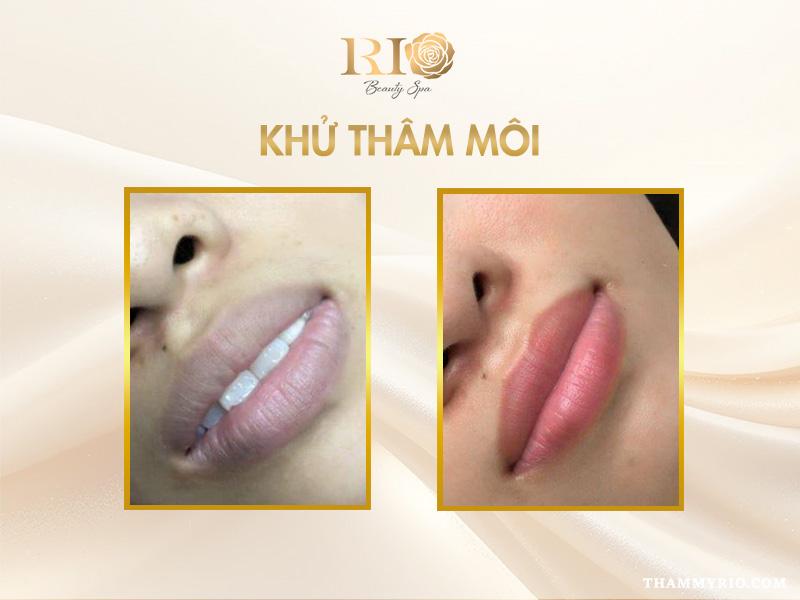 Hết thâm môi nhanh nhờ công nghệ khử thâm môi mới- Ảnh 3.