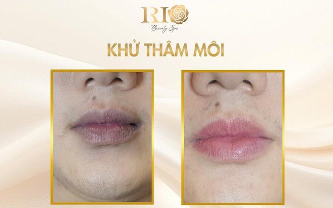 Hết thâm môi nhanh nhờ công nghệ khử thâm môi mới- Ảnh 1.