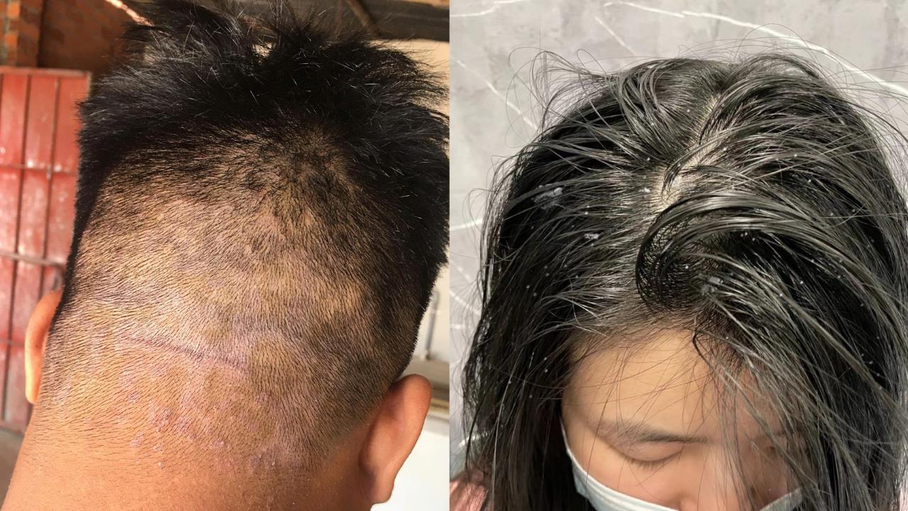 Gàu – ngứa – bết tóc mùa mưa bão: Giải pháp dịu nhẹ được nhiều chị em chia sẻ gần đây- Ảnh 3.