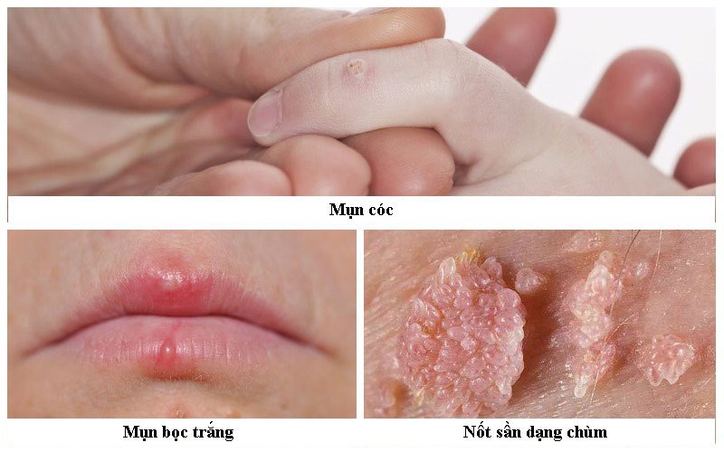 HPV - Hiểm họa trong thầm lặng: Hiểu đúng để phòng ngừa hiệu quả- Ảnh 3.