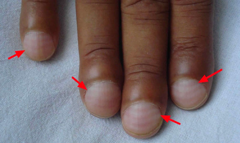 Giật mình: 5 dấu hiệu ở bàn tay cảnh báo phổi đang gặp nguy hiểm- Ảnh 2.