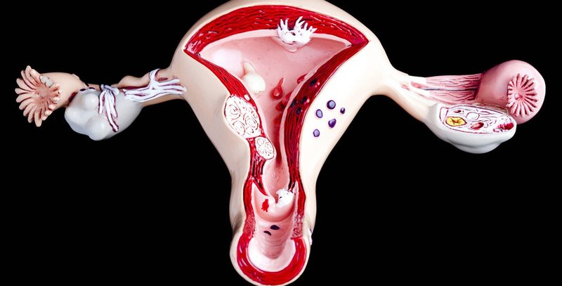 Coi thường kinh nguyệt không đều ở giai đoạn tiền mãn kinh, người phụ nữ bị lạc nội mạc tử cung nghiêm trọng- Ảnh 2.
