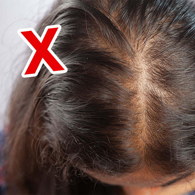 2 sai lầm khiến chị em rụng tóc và gàu dai dẳng, chuyên gia chỉ cách khắc phục- Ảnh 1.