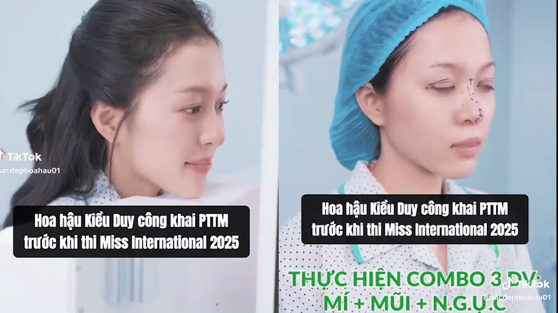 Thêm Hoa hậu 2k3 nhà Sen Vàng công khai “dao kéo” trước thềm thi Quốc tế- Ảnh 1.