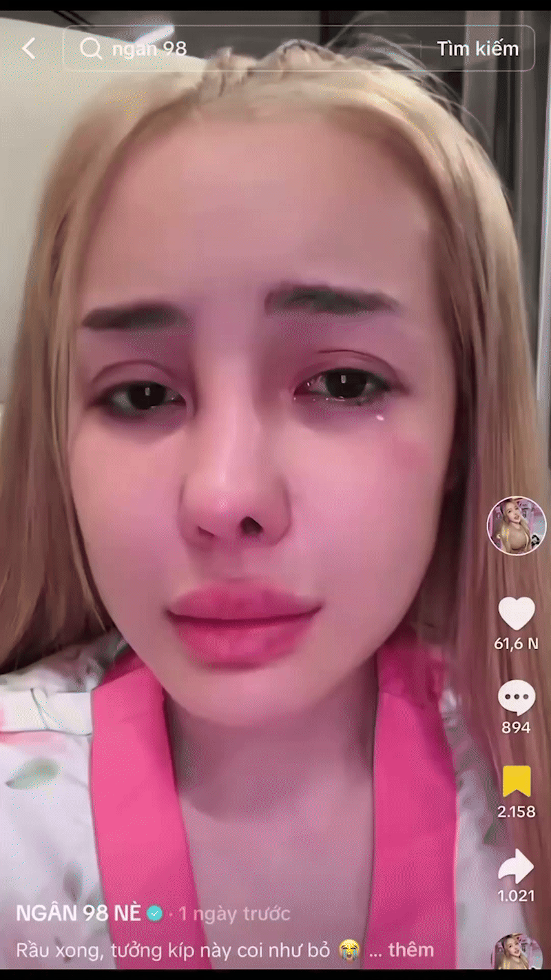 Ngân 98 bị biến chứng nhiễm trùng nặng sau 11 lần phẫu thuật thẩm mỹ- Ảnh 7. Ngân 98 bị biến chứng nhiễm trùng nặng sau 11 lần phẫu thuật thẩm mỹ- Ảnh 7.