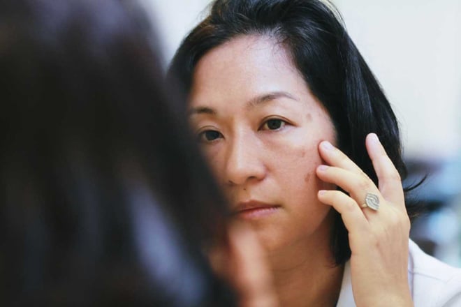 Nám da: Làm thế nào để điều trị hiệu quả theo khuyến cáo của chuyên gia da liễu?- Ảnh 2.