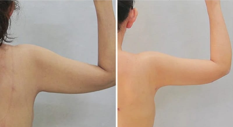 Hình ảnh cánh tay sau hút mỡ khiến ai cũng "bàng hoàng": Sai 1 ly đi cả sức khỏe!- Ảnh 3.