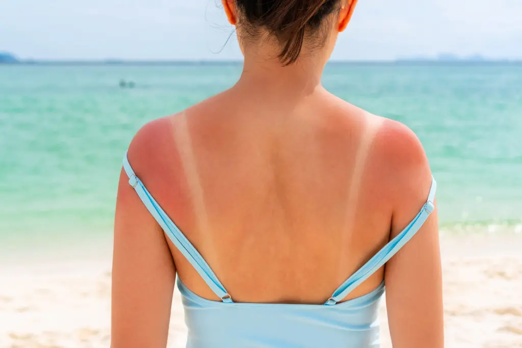 2 món nước trị cháy nắng rẻ bèo của người Việt, biết uống còn chống loãng xương- Ảnh 1.