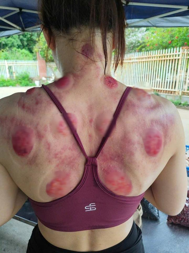 Bỏng nặng phải nhập viện vì đi giác hơi chữa đau mỏi vai gáy: Trước khi làm cần ghi nhớ điều quan trọng- Ảnh 1.
