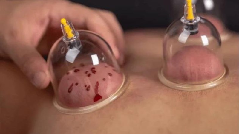 Bỏng nặng phải nhập viện vì đi giác hơi chữa đau mỏi vai gáy: Trước khi làm cần ghi nhớ điều quan trọng- Ảnh 3.