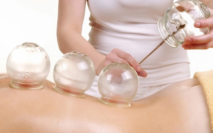 Bỏng nặng phải nhập viện vì đi giác hơi chữa đau mỏi vai gáy: Trước khi làm cần ghi nhớ điều quan trọng- Ảnh 4.
