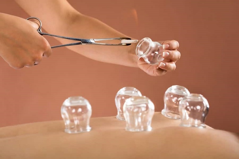 Bỏng nặng phải nhập viện vì đi giác hơi chữa đau mỏi vai gáy: Trước khi làm cần ghi nhớ điều quan trọng- Ảnh 5.