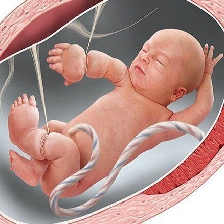 Thai nhi 21 tuần bị cắt cụt các ngón tay vì một thứ "sắc hơn dao" ngay trong bụng mẹ: Nguy hiểm nhưng khó phát- Ảnh 3.