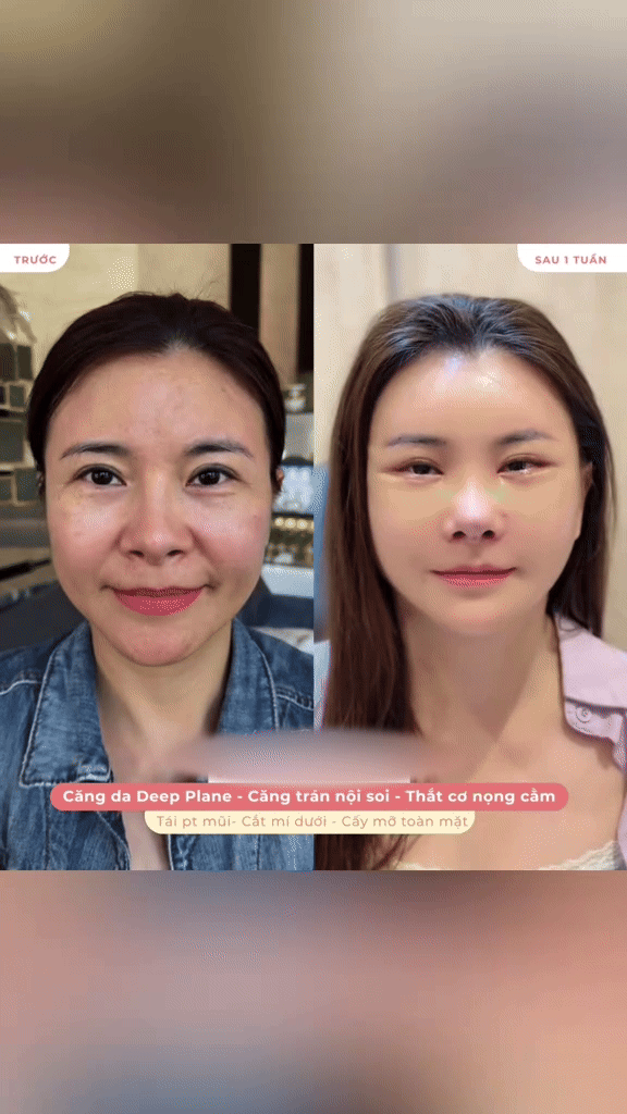 Diễn viên Vbiz "đập mặt xây lại" ở Hàn: Mặt băng bó chằng chịt, 2 đêm đầu khó chịu không thể thở- Ảnh 3.