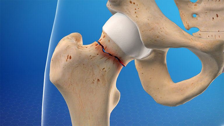 Phụ nữ mãn kinh khó tránh loãng xương: Nếu bạn không thuộc 3 nhóm sau thì xin chúc mừng!- Ảnh 2. Phụ nữ mãn kinh khó tránh loãng xương: Nếu bạn không thuộc 3 nhóm sau thì xin chúc mừng!- Ảnh 2.