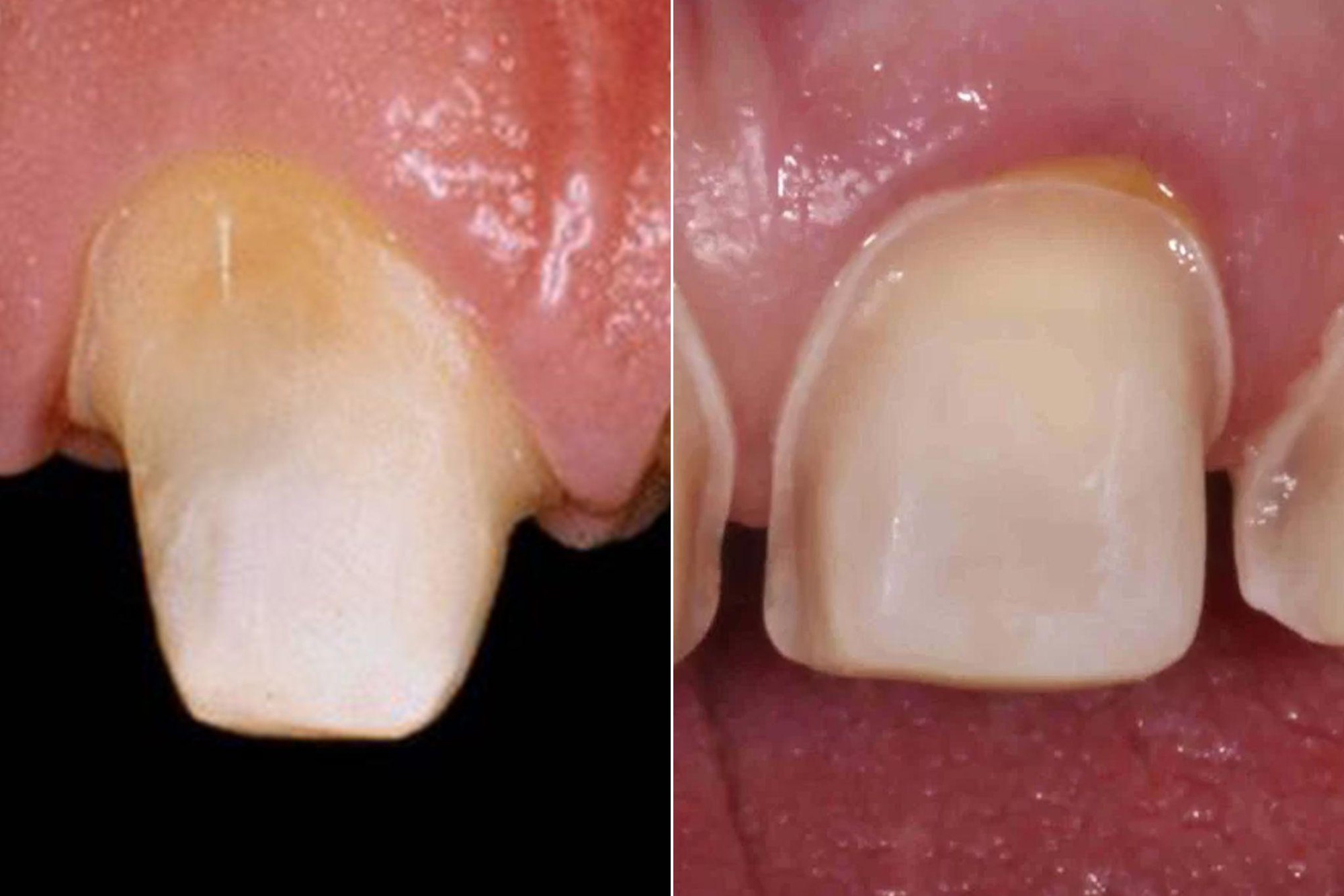 Dán sứ Veneer: Khi thẩm mỹ răng gắn liền bảo tồn- Ảnh 2.