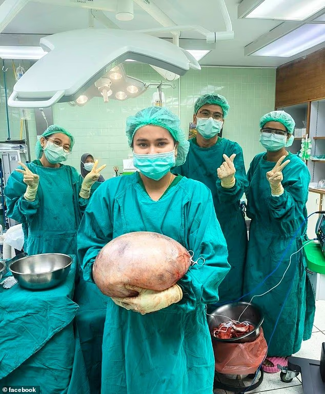 Người phụ nữ suýt mất mạng vì “bụng mỡ” hóa ra là… khối u buồng trứng nặng 7,7kg.- Ảnh 1.