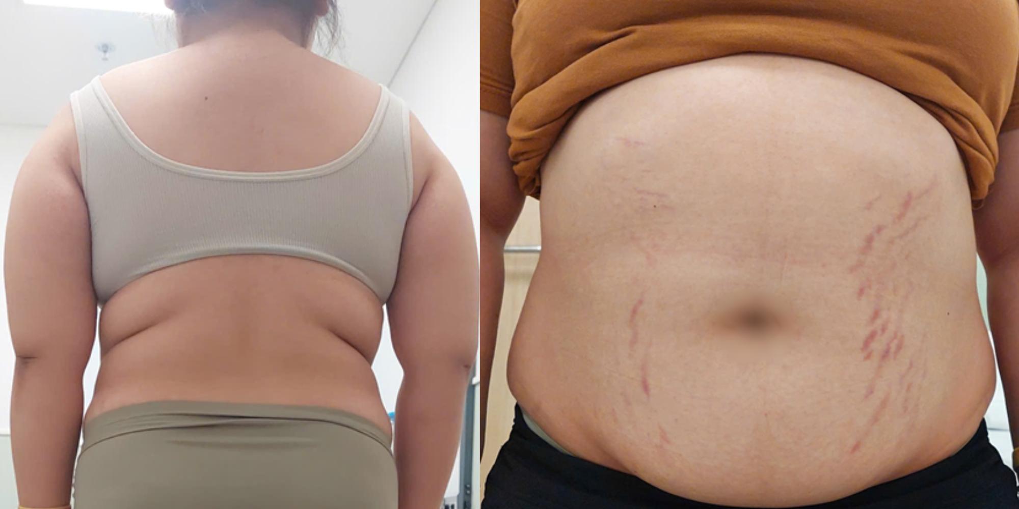 Bé gái 14 tuổi tăng 20kg, lùn đi 6cm vì căn bệnh siêu hiếm- Ảnh 1.