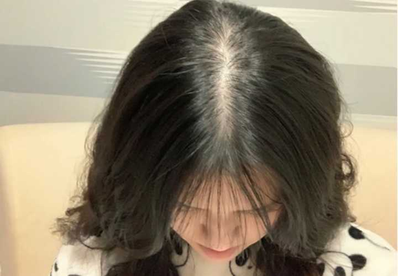 Cô gái 20 tuổi rụng sạch lông tóc chỉ trong 1 tháng sau chia tay người yêu- Ảnh 2.