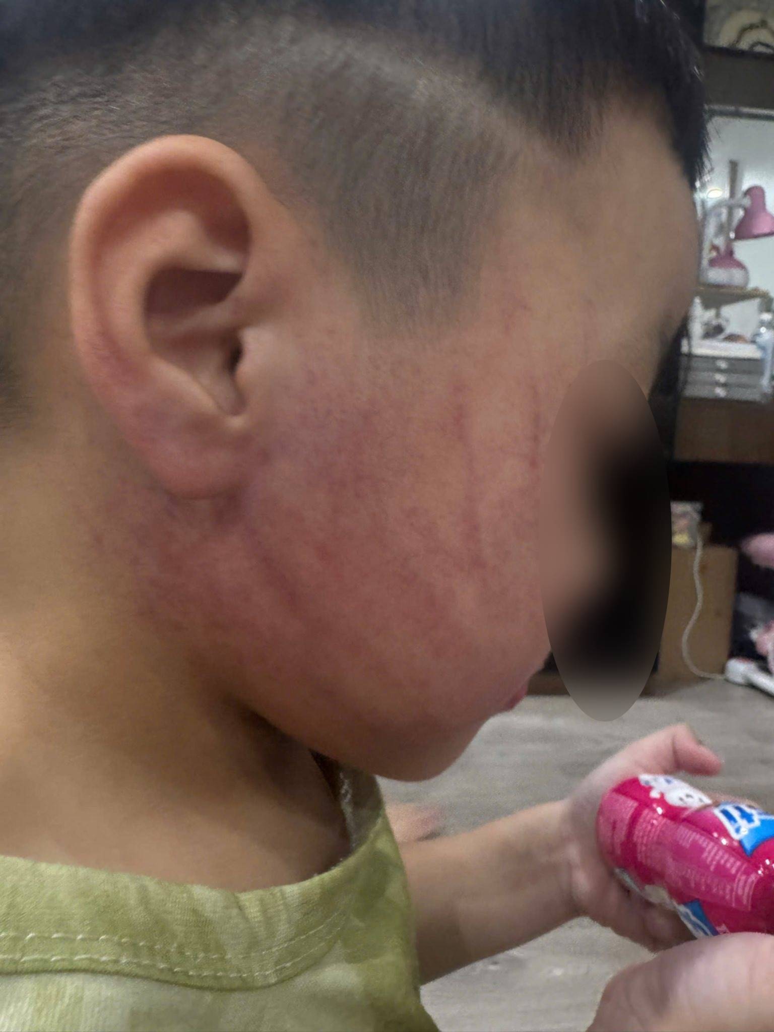 Xôn xao hình ảnh bé trai ở Hà Nội bị đánh tím mặt, phụ huynh phẫn nộ tố đích danh giáo viên- Ảnh 3.